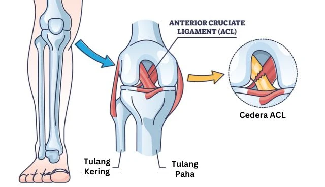 Mengenal Cedera ACL & Pemulihannya. Bisa Olahraga Lagi!