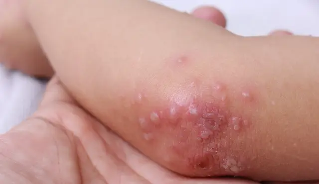 Campak Rubella: Cara Efektif Melindungi Anak dari Penyakit Menular