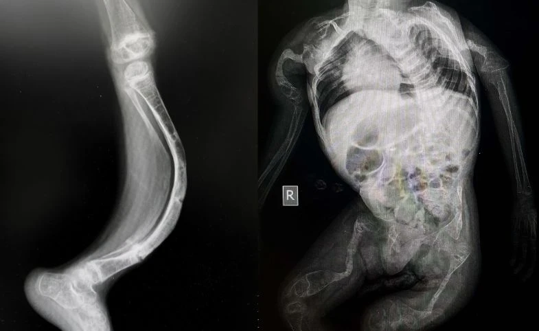 Osteogenesis Imperfecta (OI), Penyakit Langka Penyebab Tulang Rapuh