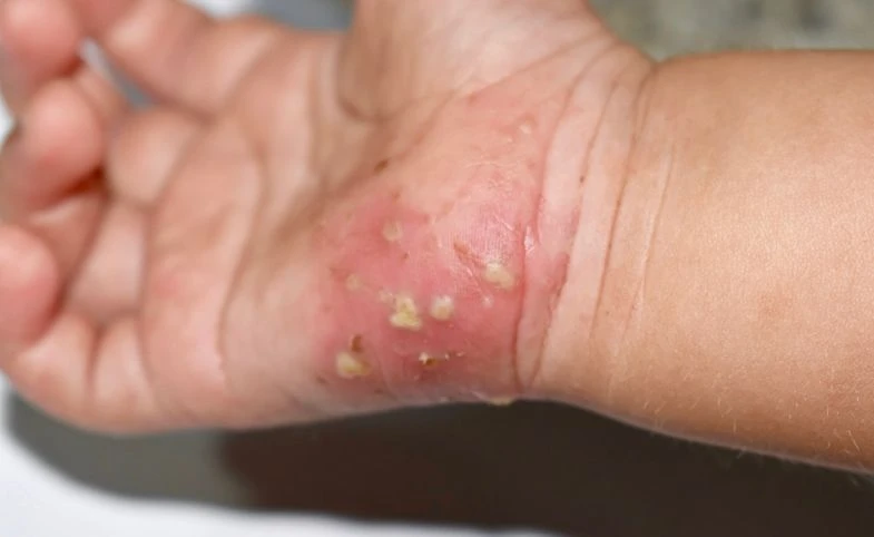 Kenali Kudis (Skabies) yang Disebabkan Tungau & Pengobatannya