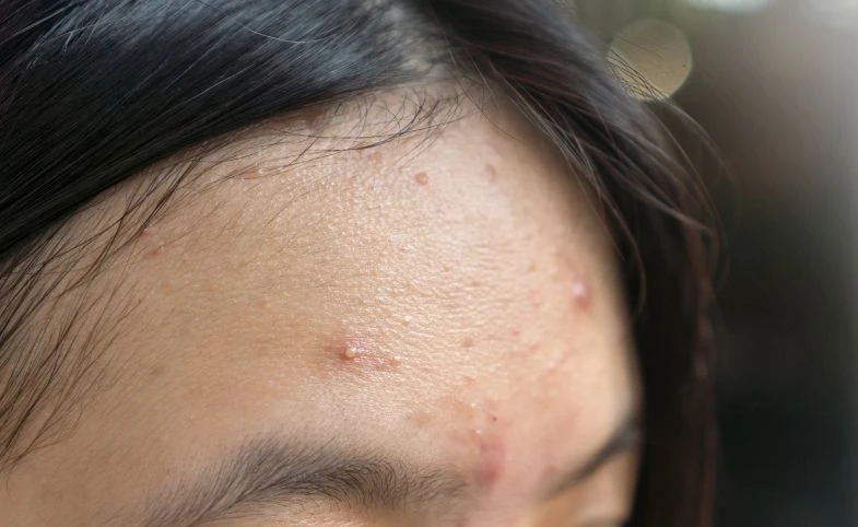 Jerawat Muncul Jelang Nikah? Ini Cara Cepat Hilangin Sebelum Hari-H!